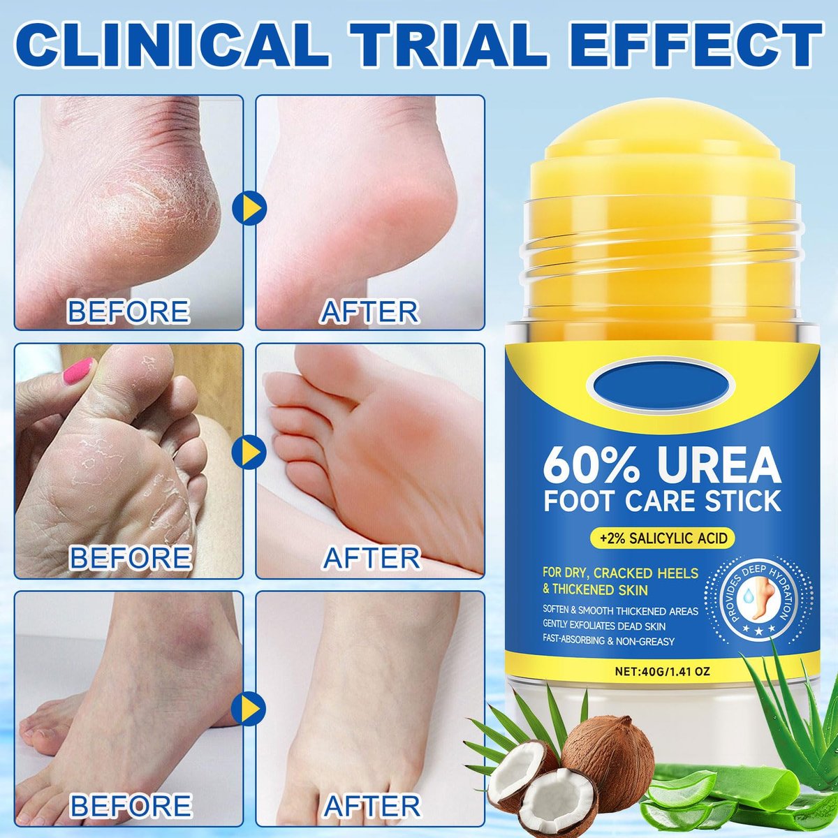 SPRINGSUGAR 60% Urea Foot Cream Stick with 2% Salicylic Acid – Extra-Strength Cracked Heel Repair for Dry Feet & Calluses, Moisturizing Urea Cream Stick for Dead Skin Removal, Heel Balm for Rough Skin (2-Pack) Avelisse