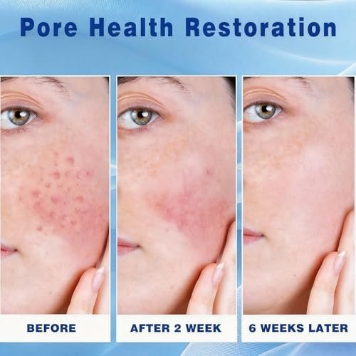 2 PCS Azelaic Acid Cream for Face - Moisturizer with Hyaluronic Acid for Redness, Acne Breakouts, and Oil Balance - görsel 6