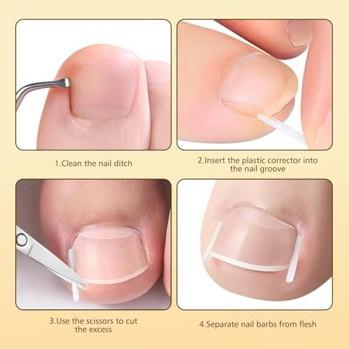 Ingrown Toenail Corrector Set with Magnifier and Correction Strips – Professional Treatment Tools for Safe Home Nail Care Avelisse