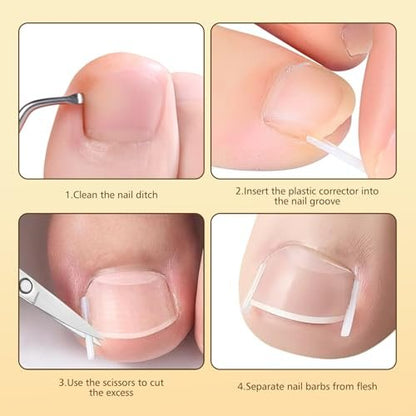 Ingrown Toenail Corrector Set with Magnifier and Correction Strips – Professional Treatment Tools for Safe Home Nail Care Avelisse
