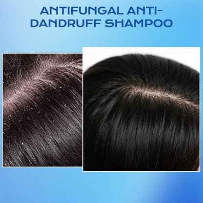 FYZMTL Anti-Dandruff Shampoo - Anti-Fungal Scalp Treatment for Folliculitis, Seborrheic Dermatitis & Scalp Psoriasis, Itchy Scalp Relief & Hydrating Dry Scalp Care for Men & Women (6.75 Fl Oz)