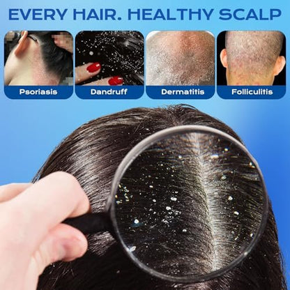 FYZMTL Anti-Dandruff Shampoo - Anti-Fungal Scalp Treatment for Folliculitis, Seborrheic Dermatitis & Scalp Psoriasis, Itchy Scalp Relief & Hydrating Dry Scalp Care for Men & Women (6.75 Fl Oz)