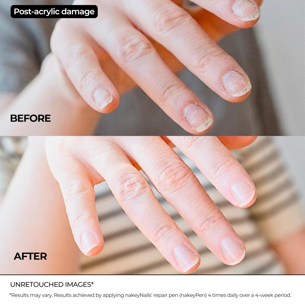 Nail Repair Pen for Damaged, Brittle & Thin Nails — Post-Acrylic & Gel Damage Treatment with Keratin, Peptides, Hyaluronic Acid & Niacinamide — Dermatologist Tested, 45-Day Supply by nakeyNails Avelisse