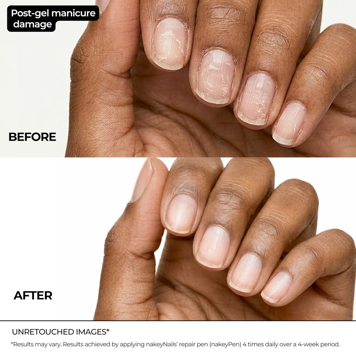 Nail Repair Pen for Damaged, Brittle & Thin Nails — Post-Acrylic & Gel Damage Treatment with Keratin, Peptides, Hyaluronic Acid & Niacinamide — Dermatologist Tested, 45-Day Supply by nakeyNails Avelisse