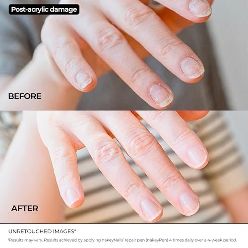 Nail Repair Pen for Damaged, Brittle & Thin Nails — Post-Acrylic & Gel Damage Treatment with Keratin, Peptides, Hyaluronic Acid & Niacinamide — Dermatologist Tested, 45-Day Supply by nakeyNails Avelisse