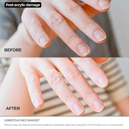 Nail Repair Pen for Damaged, Brittle & Thin Nails — Post-Acrylic & Gel Damage Treatment with Keratin, Peptides, Hyaluronic Acid & Niacinamide — Dermatologist Tested, 45-Day Supply by nakeyNails Avelisse