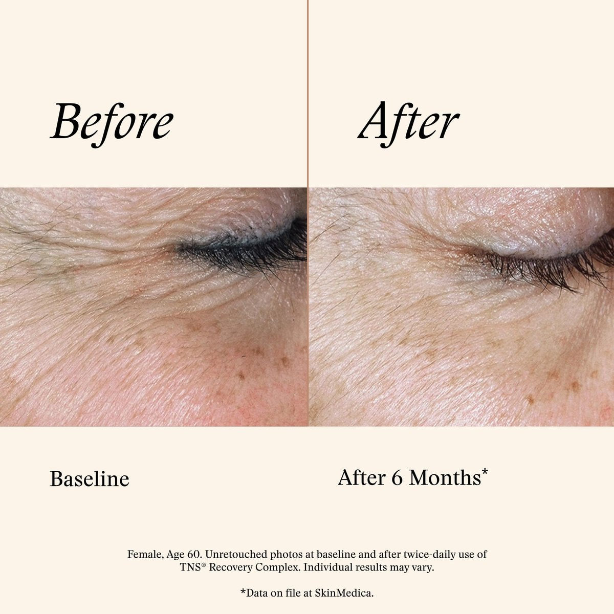 SkinMedica TNS Recovery Complex Facial Treatment - Advanced Growth Factor & Exosome Serum for Skin Rejuvenation, Fine Lines & Wrinkles, 1 oz Avelisse