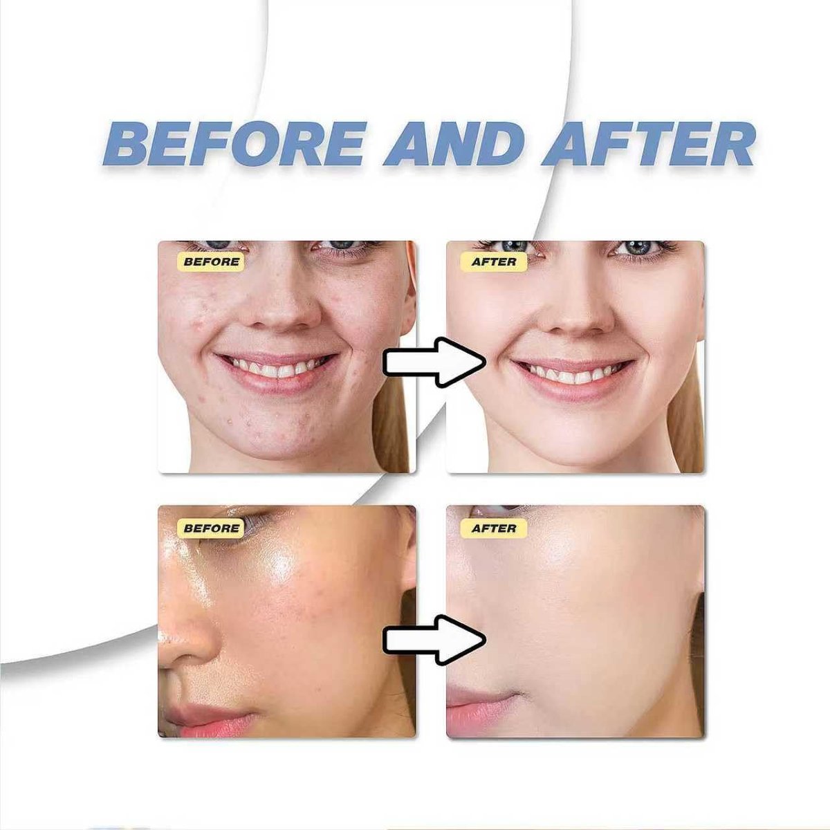 20% Azelaic Acid Cream with Hyaluronic Acid - Soothing Face Moisturizer for Redness, Acne, and Excess Oil - görsel 11