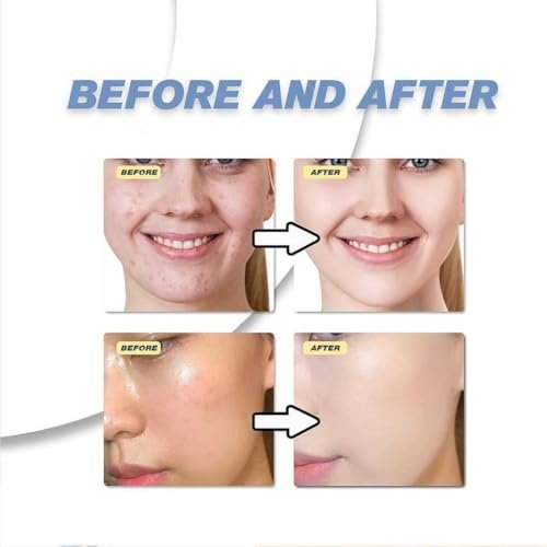 20% Azelaic Acid Cream with Hyaluronic Acid - Soothing Face Moisturizer for Redness, Acne, and Excess Oil - görsel 12