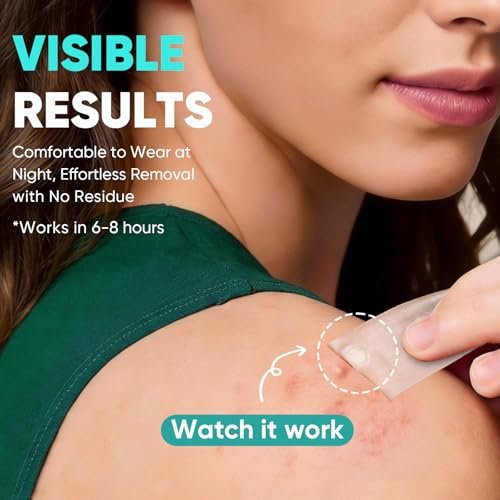 Kindshine 96 Count XL Pimple Patches - Hydrocolloid Acne Patches for Face & Body, Vegan Cruelty-Free Blemish Spot Stickers, Invisible Zit Covers for Chin, Back, Forehead - görsel 5