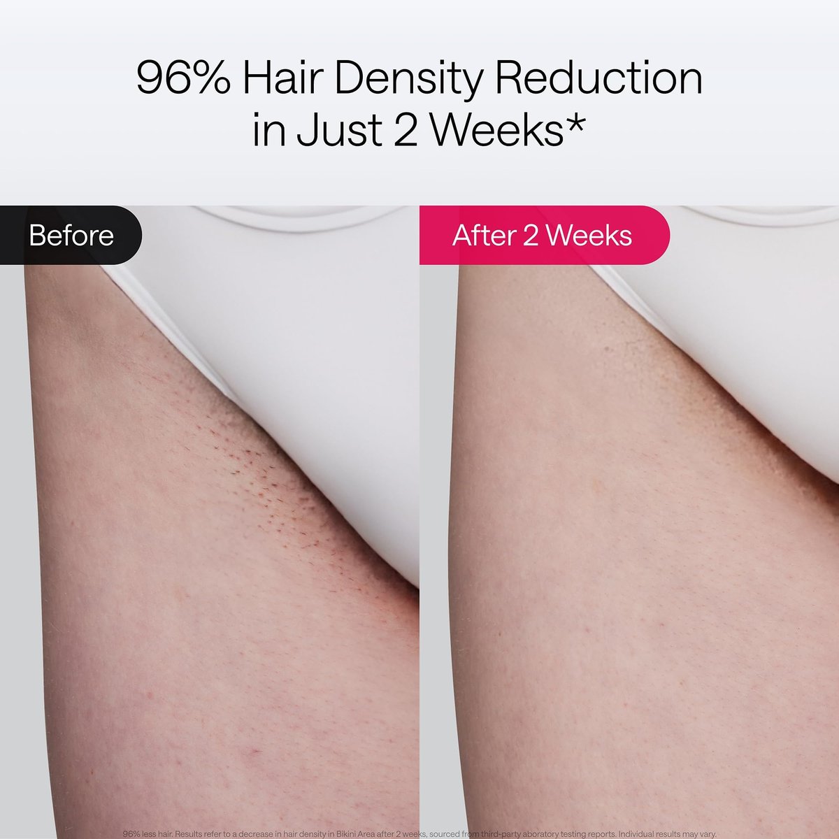 Ulike Air 10 Deluxe Edition IPL Laser Hair Removal Device for Women and Men – Ice-Cooling Technology, Nearly Painless & Permanent Hair Reduction at Home in 10 Minutes Avelisse
