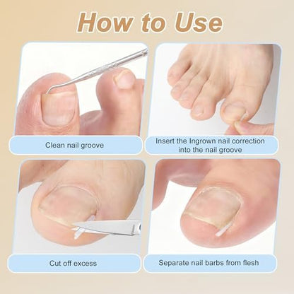 VOCOSTE Ingrown Toenail Correction Kit – Professional Toe Nail Corrector Tools with Leather Case for Curved & Ingrown Nails, Includes Nail Files, Clipper & Lifter Avelisse