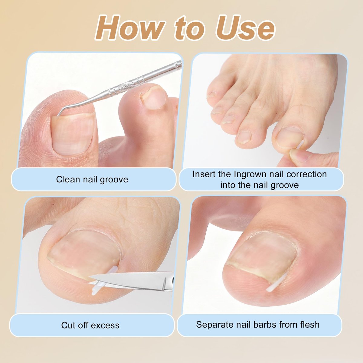 VOCOSTE Ingrown Toenail Correction Kit – Professional Toe Nail Corrector Tools with Leather Case for Curved & Ingrown Nails, Includes Nail Files, Clipper & Lifter Avelisse