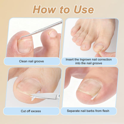 VOCOSTE Ingrown Toenail Correction Kit – Professional Toe Nail Corrector Tools with Leather Case for Curved & Ingrown Nails, Includes Nail Files, Clipper & Lifter Avelisse