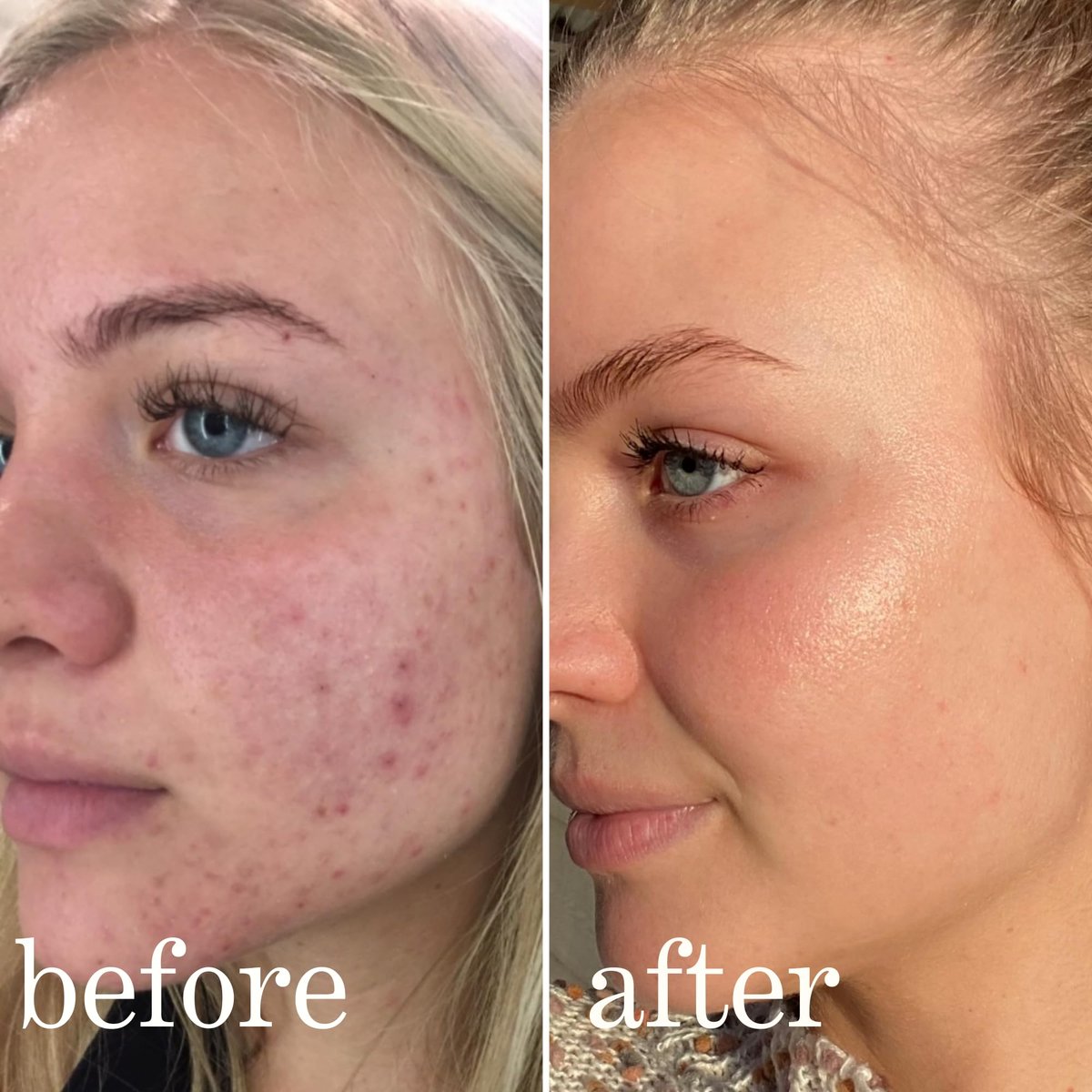 Mandelic Acid Serum Toner Exfoliant | Acne Redness & Balancing Treatment with Niacinamide, Licorice Root & Hyaluronic Acid | Hydrating Exfoliator (Lissy Skincare, 1 fl oz) Avelisse