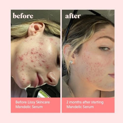 Mandelic Acid Serum Toner Exfoliant | Acne Redness & Balancing Treatment with Niacinamide, Licorice Root & Hyaluronic Acid | Hydrating Exfoliator (Lissy Skincare, 1 fl oz) Avelisse
