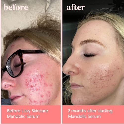 Mandelic Acid Serum Toner Exfoliant | Acne Redness & Balancing Treatment with Niacinamide, Licorice Root & Hyaluronic Acid | Hydrating Exfoliator (Lissy Skincare, 1 fl oz) Avelisse