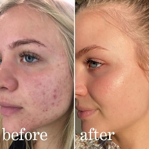 Mandelic Acid Serum Toner Exfoliant | Acne Redness & Balancing Treatment with Niacinamide, Licorice Root & Hyaluronic Acid | Hydrating Exfoliator (Lissy Skincare, 1 fl oz) Avelisse