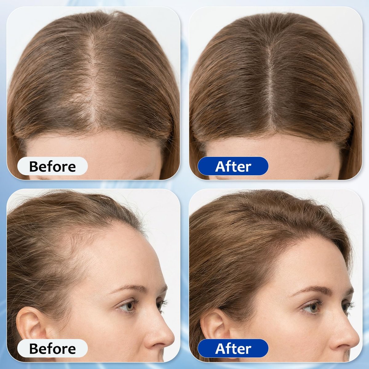 Hair Growth Serum Roll On with 3% Rosemary, 3% Batana Oil, 2% Pea Extract, 2% Ginger Root Oil - Thicker Hair & Stronger Roots (30ml) Avelisse