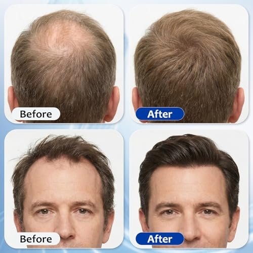 Hair Growth Serum Roll On with 3% Rosemary, 3% Batana Oil, 2% Pea Extract, 2% Ginger Root Oil - Thicker Hair & Stronger Roots (30ml) Avelisse