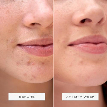 Vue Surface Clearing Patches - Large Pimple Patches for Face & Body, Hydrocolloid Acne Patch for Clusters, Breakouts and Oil Control, Gentle for Sensitive Skin (10-Count) Avelisse