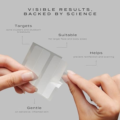 Vue Surface Clearing Patches - Large Pimple Patches for Face & Body, Hydrocolloid Acne Patch for Clusters, Breakouts and Oil Control, Gentle for Sensitive Skin (10-Count) Avelisse