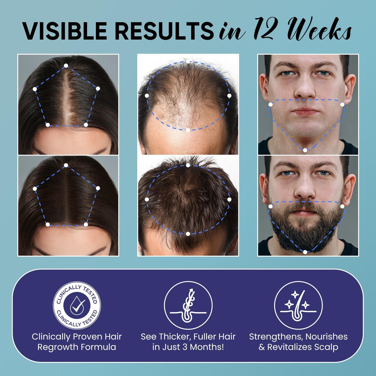 5% Minoxidil Hair Growth Kit for Men and Women - Spray Treatment with Biotin & Rosemary, Stop Hair Loss, Stronger Thicker Hair, 2 Pack Avelisse