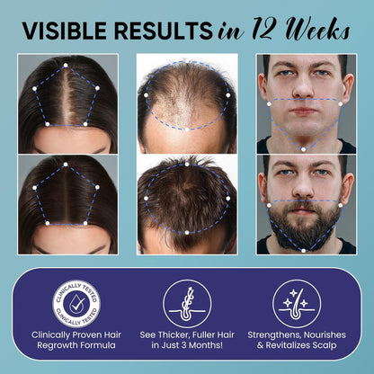 5% Minoxidil Hair Growth Kit for Men and Women - Spray Treatment with Biotin & Rosemary, Stop Hair Loss, Stronger Thicker Hair, 2 Pack Avelisse