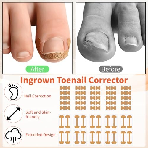 Ingrown Toenail Removal Kit - Complete Corrector Tool with Correction Strips, Toe Separators, Painless File and Lifter for Home Pedicure Care - görsel 8