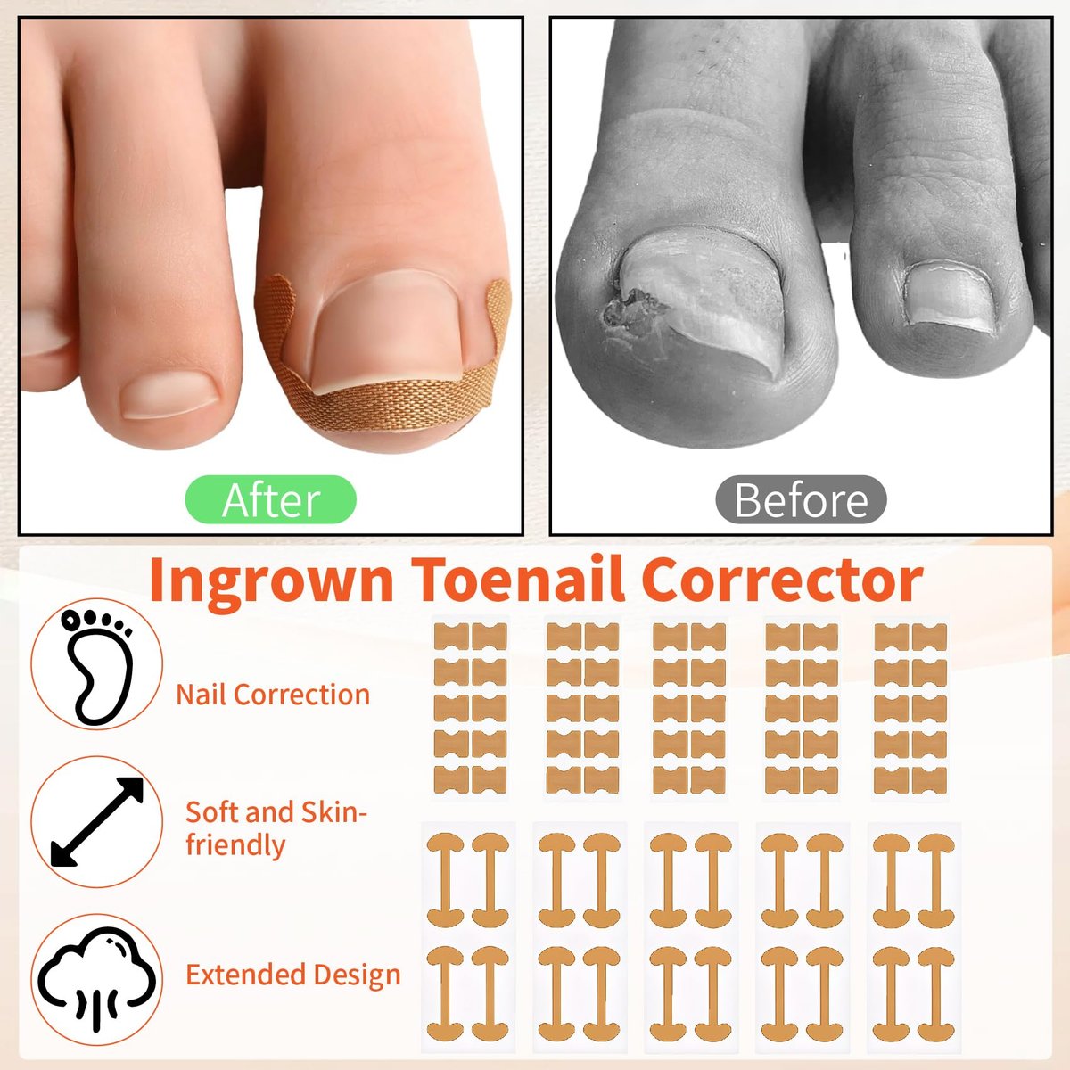 Ingrown Toenail Removal Kit - Complete Corrector Tool with Correction Strips, Toe Separators, Painless File and Lifter for Home Pedicure Care - görsel 7