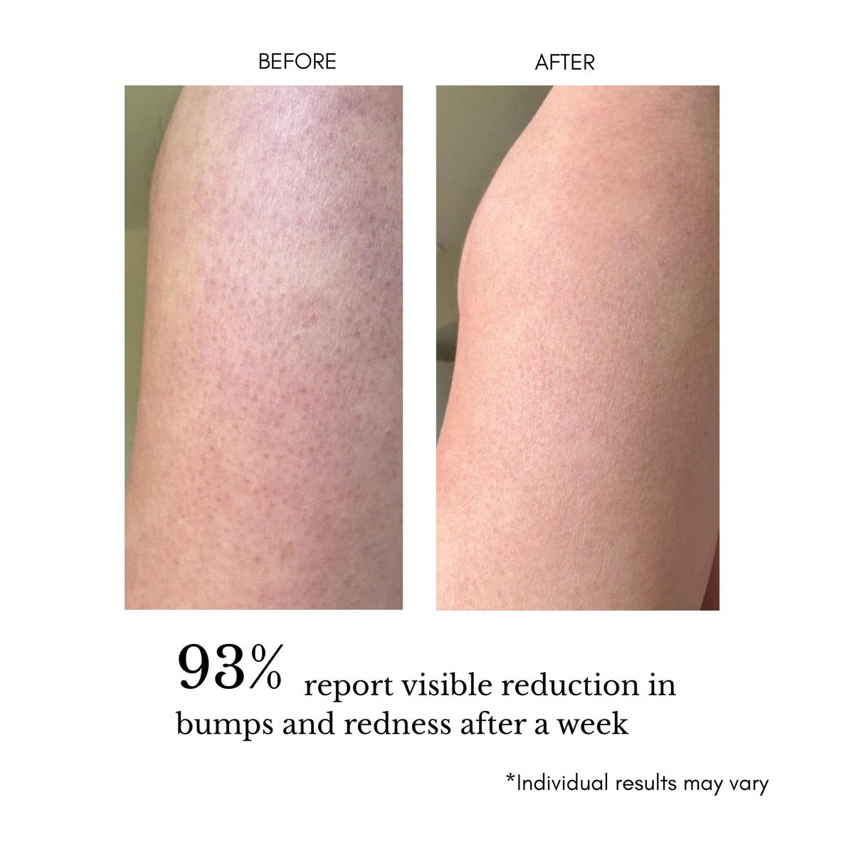 klarifyScience Texture Refining Body Serum for KP, Ingrown Hairs & Body Breakouts – Advanced Triple-Action Formula with Glycolic Acid & Squalane (AHA/BHA/PHA) – 120 ml Avelisse