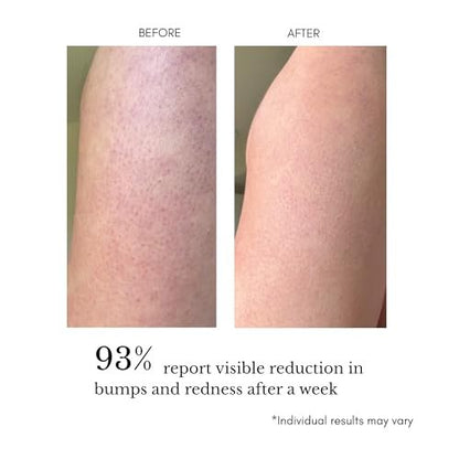 klarifyScience Texture Refining Body Serum for KP, Ingrown Hairs & Body Breakouts – Advanced Triple-Action Formula with Glycolic Acid & Squalane (AHA/BHA/PHA) – 120 ml Avelisse