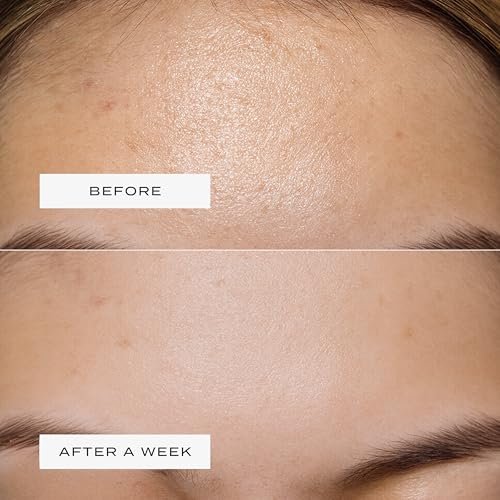 Vue Forehead Patches – Hydrocolloid Pore Patches for T-Zone Oil Control, Breakouts & Pimples, Gentle on All Skin Types (5 Count) Avelisse