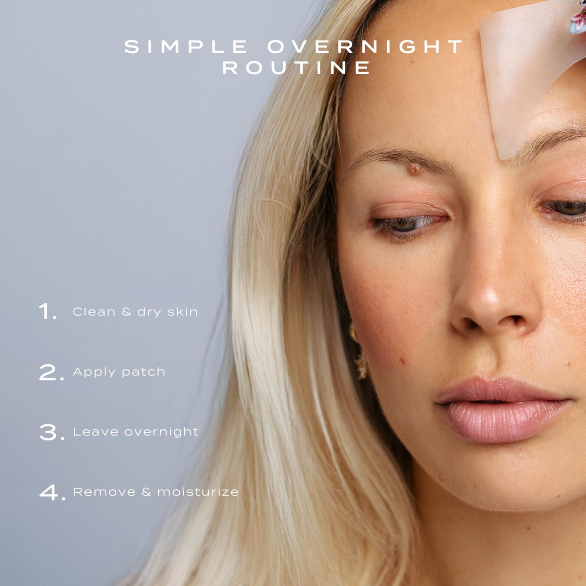 Vue Forehead Patches – Hydrocolloid Pore Patches for T-Zone Oil Control, Breakouts & Pimples, Gentle on All Skin Types (5 Count) Avelisse