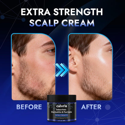 Calvris Extra Strength Scalp Cream – Flake & Itch Relief for Dandruff and Dry Scalp, Enhanced Botanical Formula, 3.4 fl oz Avelisse