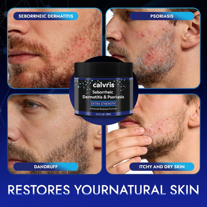 Calvris Extra Strength Scalp Cream – Flake & Itch Relief for Dandruff and Dry Scalp, Enhanced Botanical Formula, 3.4 fl oz Avelisse
