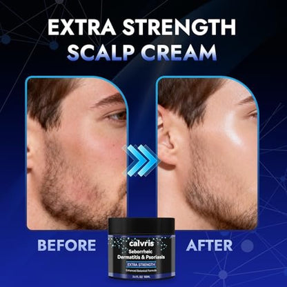 Calvris Extra Strength Scalp Cream – Flake & Itch Relief for Dandruff and Dry Scalp, Enhanced Botanical Formula, 3.4 fl oz Avelisse