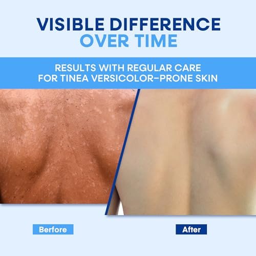 Hermon Tinea Versicolor Soap 2 Bars - Clinically Proven Multi-Functional Treatment for Tinea Versicolor, Athlete's Foot, Jock Itch, Ringworm - Fast Acting, Soothes, Cleanses, and Restores Skin Health Avelisse