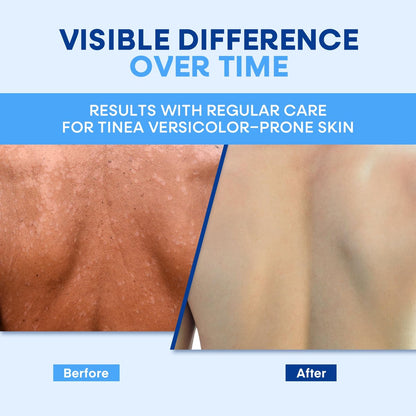 Hermon Tinea Versicolor Soap 2 Bars - Clinically Proven Multi-Functional Treatment for Tinea Versicolor, Athlete's Foot, Jock Itch, Ringworm - Fast Acting, Soothes, Cleanses, and Restores Skin Health Avelisse