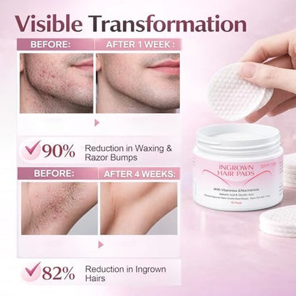 Ingrown Hair Treatment Pads for Face, Bikini Area, Underarms, Neck, Legs – BHA + AHA Soothe Razor Bumps After Shave & Waxing – 50 Pads Avelisse