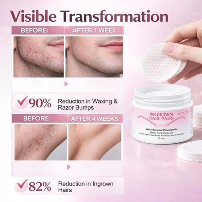 Ingrown Hair Treatment Pads for Face, Bikini Area, Underarms, Neck, Legs – BHA + AHA Soothe Razor Bumps After Shave & Waxing – 50 Pads Avelisse