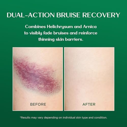 Vigority Arnica Bruise Cream - Extra Strength with Helichrysum, Vitamins K, C & E for Bruises, Mature & Thin Skin - 3.4 oz - görsel 8