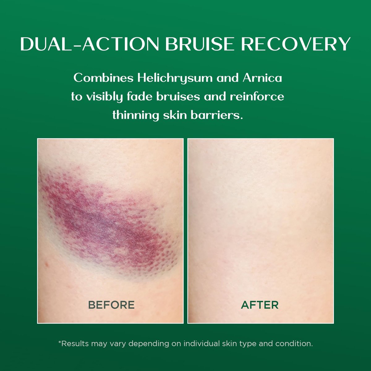 Vigority Arnica Bruise Cream - Extra Strength with Helichrysum, Vitamins K, C & E for Bruises, Mature & Thin Skin - 3.4 oz - görsel 7