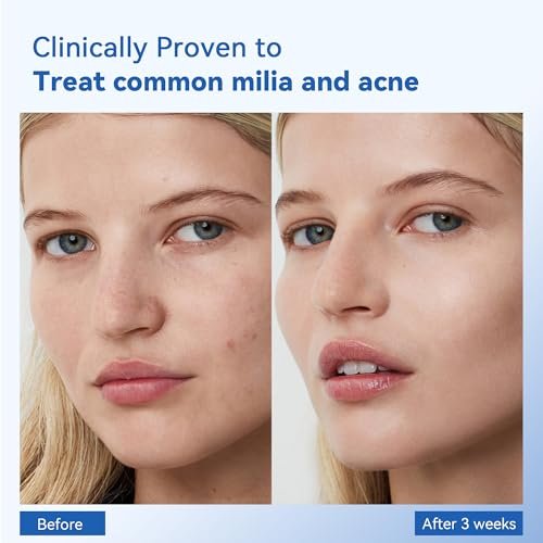 MEOLY Milia Remover Treatment Serum – BHA with Niacinamide for Milia & Acne, Advanced Exfoliant for Men and Women, 30 ML Avelisse
