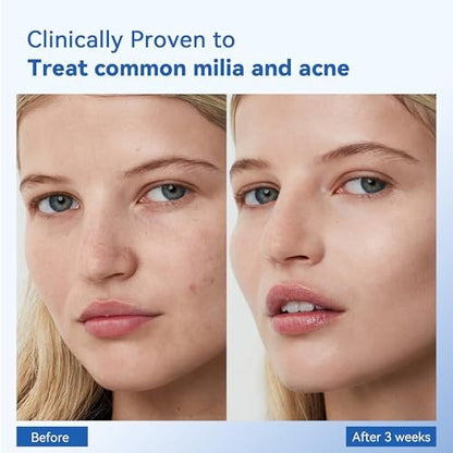 MEOLY Milia Remover Treatment Serum – BHA with Niacinamide for Milia & Acne, Advanced Exfoliant for Men and Women, 30 ML Avelisse