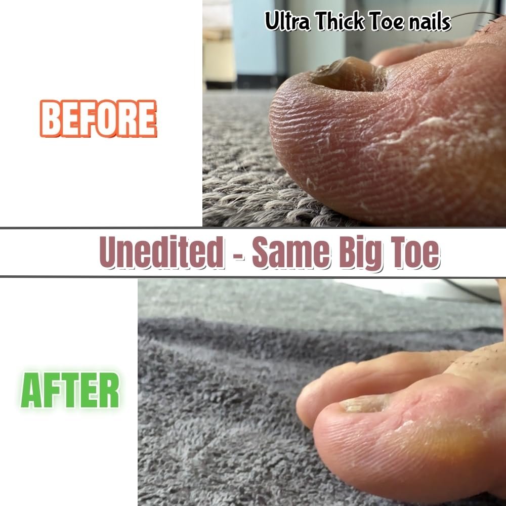 IDOU 4-in-1 Toe Nail Care Kit: Toe Nail Files for Thick Nails with Ingrown Toenail Lifter & Silicone Thumb Guard - Non-Slip Grip, 2 Metal Nail Files for Men/Seniors (Silver Lifter) Avelisse