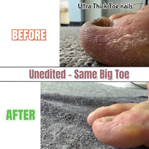 IDOU 4-in-1 Toe Nail Care Kit: Toe Nail Files for Thick Nails with Ingrown Toenail Lifter & Silicone Thumb Guard - Non-Slip Grip, 2 Metal Nail Files for Men/Seniors (Silver Lifter) Avelisse