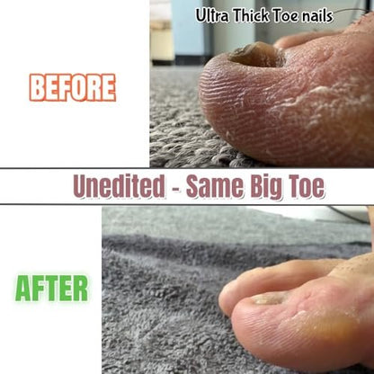 IDOU 4-in-1 Toe Nail Care Kit: Toe Nail Files for Thick Nails with Ingrown Toenail Lifter & Silicone Thumb Guard - Non-Slip Grip, 2 Metal Nail Files for Men/Seniors (Silver Lifter) Avelisse