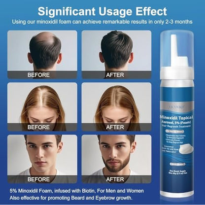 Extra Strength 5% Minoxidil Foam with Biotin – Unscented, Unisex Hair Growth Treatment for Thicker, Fuller Hair & Beard (14.77 oz, 7–8 Month Supply) Avelisse