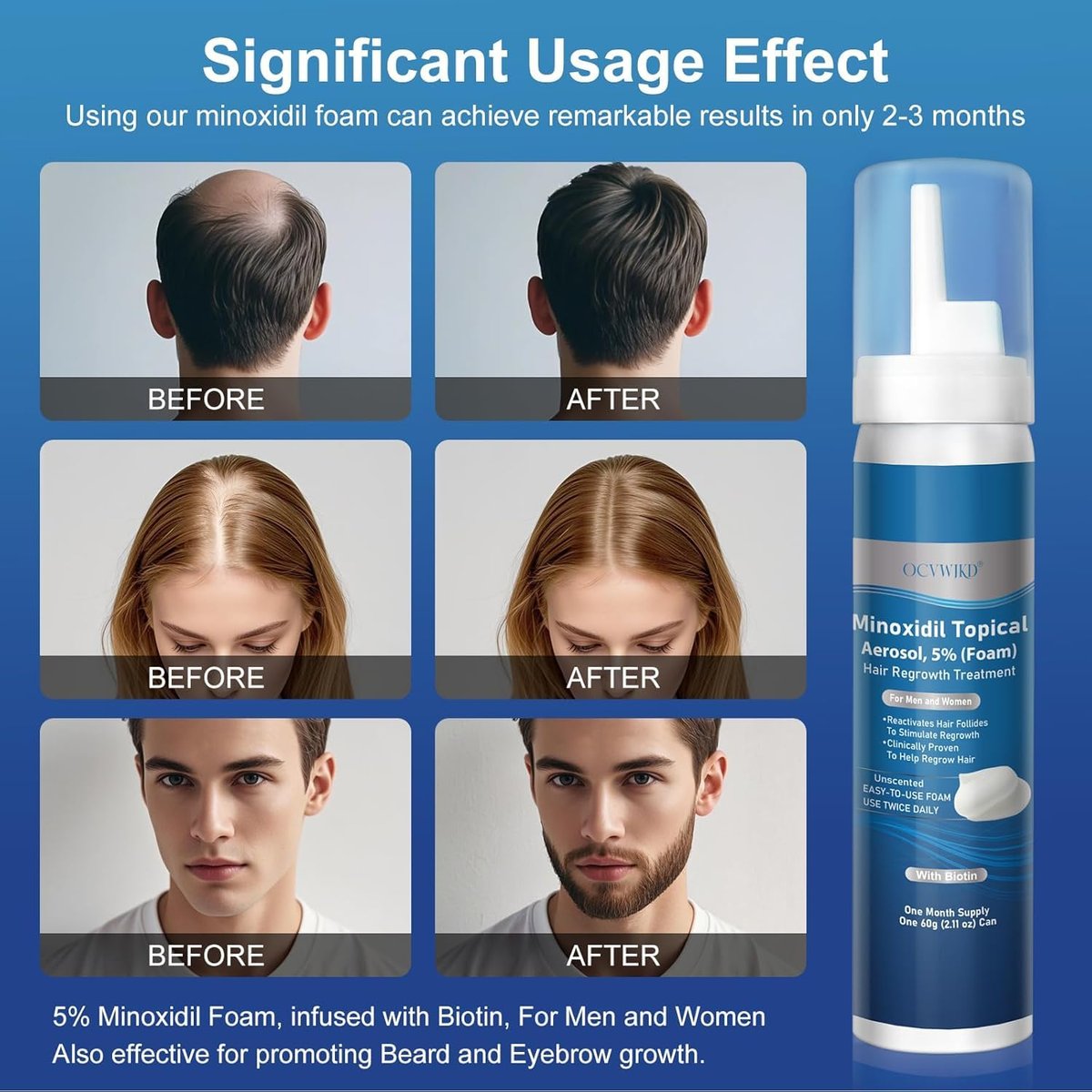 Extra Strength 5% Minoxidil Foam with Biotin – Unscented, Unisex Hair Growth Treatment for Thicker, Fuller Hair & Beard (14.77 oz, 7–8 Month Supply) Avelisse